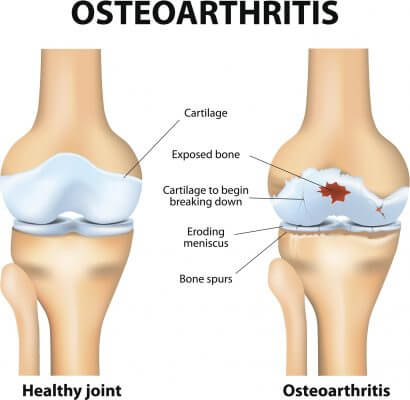 Osteoarthritis